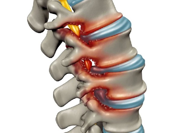 Spinal Stenoz (Dar Kanal) Rahatsızlığı