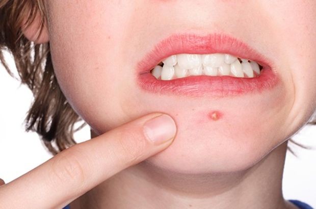 Çıbana Ne İyi Gelir?