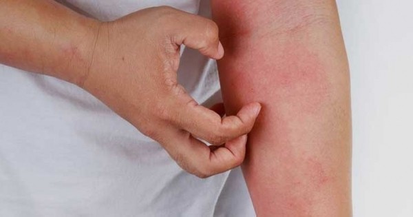 Alerji Kaşıntısına Ne İyi Gelir?