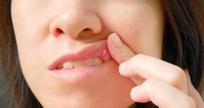 Aft Yarasına Ne İyi Gelir?