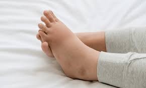 Ayak Şişliğine Ne İyi Gelir?