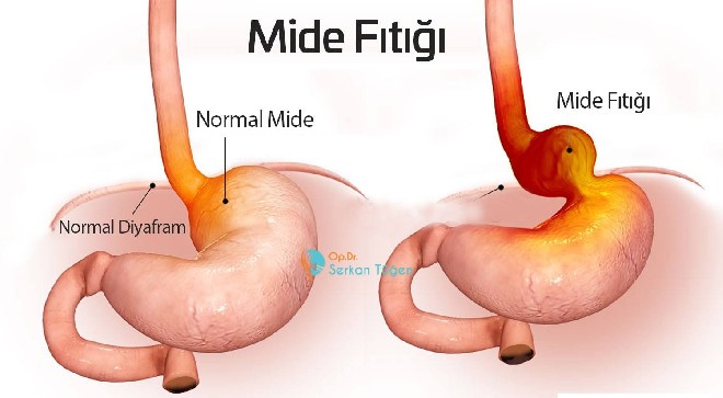 Mide Fıtığına Ne İyi Gelir