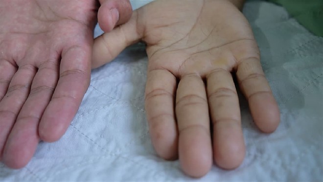 Anemi Nedir Belirtileri?