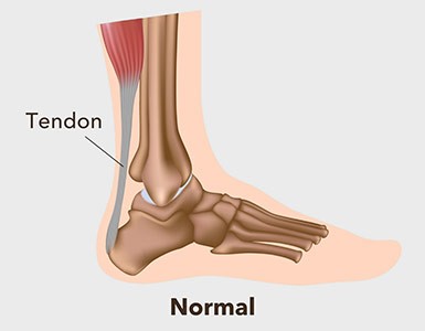 Aşil Tendonu